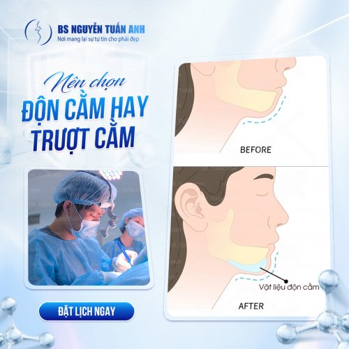 độn cằm v- line.jpg